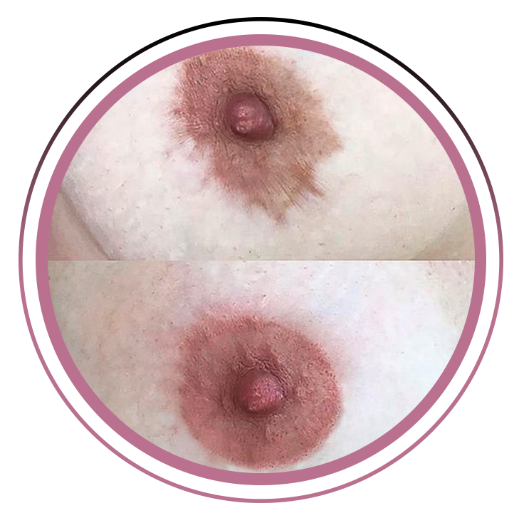 Micropigmentação paramédica