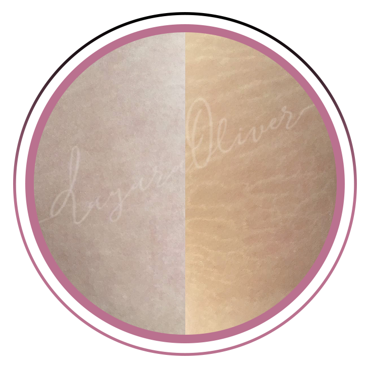 Micropuntura em estrias